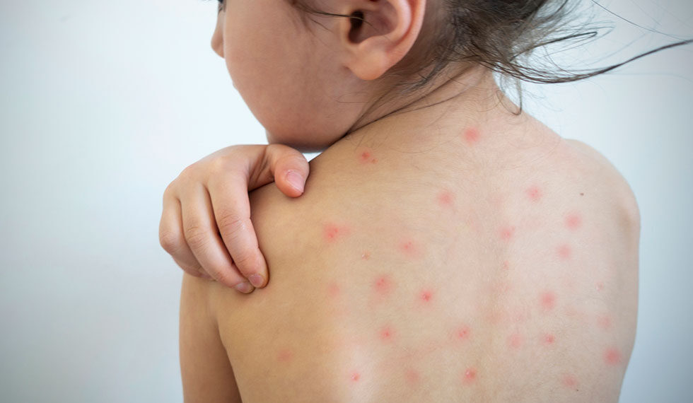Casos recentes de sarampo reforçam alerta para vacinação, destaca infectologista do HSANP