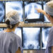 Diagnóstico precoce e cirurgia minimamente invasiva transformam o tratamento do câncer de pulmão no Brasil