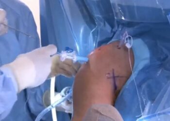 Navegação em tempo real amplia precisão em cirurgias complexas de ombro