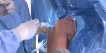 Navegação em tempo real amplia precisão em cirurgias complexas de ombro