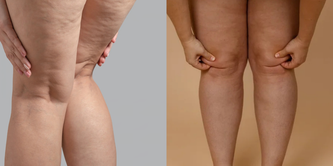 Lipedema: doença crônica vai além da questão estética