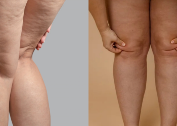 Lipedema: doença crônica vai além da questão estética
