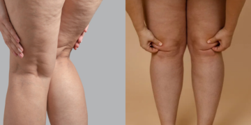 Lipedema: doença crônica vai além da questão estética
