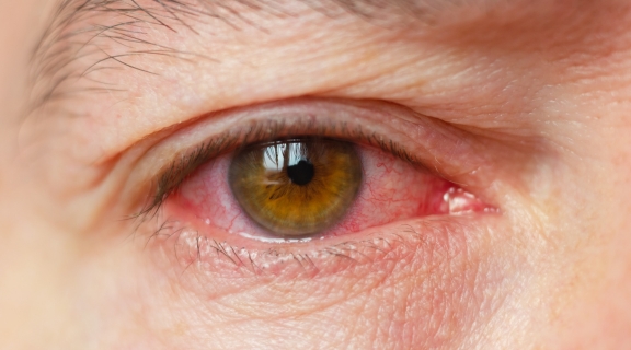 Retinopatia diabética pode avançar sem sintomas: acompanhamento oftalmológico ajuda a proteger a visão