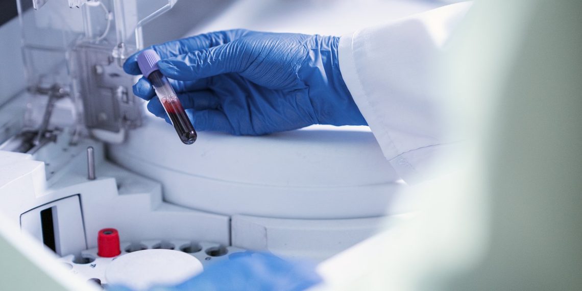 Exame de sangue para detectar Alzheimer chega ao Brasil