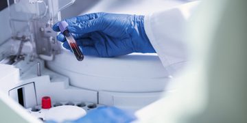 Exame de sangue para detectar Alzheimer chega ao Brasil