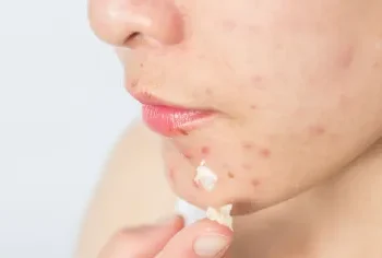 Estudo preliminar internacional revela que 1 em cada 4 brasileiros tem acne e o impacto vai muito além da pele 