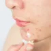 Estudo preliminar internacional revela que 1 em cada 4 brasileiros tem acne e o impacto vai muito além da pele