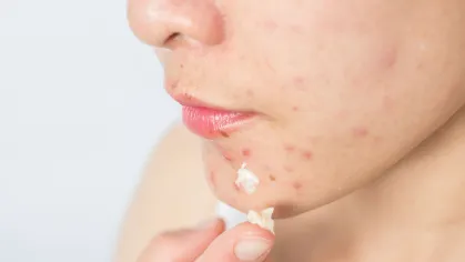 Estudo preliminar internacional revela que 1 em cada 4 brasileiros tem acne e o impacto vai muito além da pele 