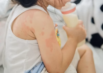 Mês das Crianças: como descobrir se seu filho tem alergia ou intolerância alimentar? Saiba como os testes genéticos auxiliam no diagnóstico