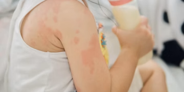 Mês das Crianças: como descobrir se seu filho tem alergia ou intolerância alimentar? Saiba como os testes genéticos auxiliam no diagnóstico
