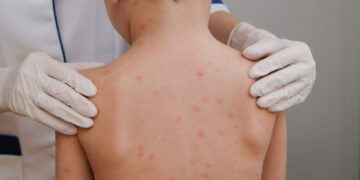 Dia Mundial da Meningite: Pesquisa global revela que só 19% dos pais e 10% dos jovens no Brasil sabem que a meningite meningocócica pode se tornar fatal em poucas horas
