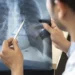Câncer de pulmão: pesquisa aponta frequência de mutação do gene EGFR