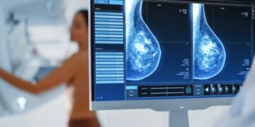 Além da mamografia: como genética e novos exames estão mudando a investigação do câncer de mama