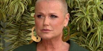 Saiba como a alopecia se manifesta