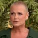 Saiba como a alopecia se manifesta